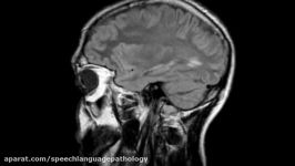 Brain MRI  Multiple Sclerosis