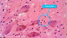 What is Dementia with Lewy Bodies