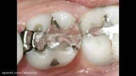 Failed Amalgam Fillings  Lake Merritt Dental Oakland CA