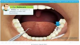 Amalgam Dental Filling