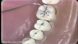 Class I Amalgam Restoration