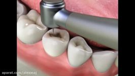 Amalgam Fillings Procedure  Lake Merritt Dental Oakland CA