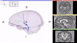 Ventral Tegmental Area  DTI of the Dopaminergic pathway