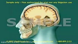 Traumatic Brain Injury TBI Part 2 2D3D Medical Animation