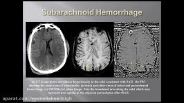 Imaging Traumatic Brain Injury