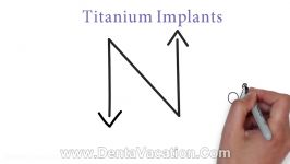 zIrconia vs Titanium Dental Implant