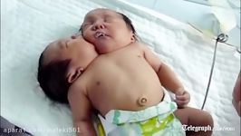 Two headed baby Amazing conjoined twins born in China