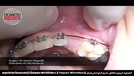 Surgical Exposure of Impacted Canine