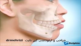 جراحی ارتودنسی اپن بایت