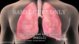 Lung Cancer Staging Non small Cell