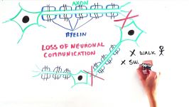 WHAT IS MLD Metachromatic Leukodystrophy explained to all