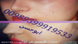 تجمیل الانف زرع الشعر فی ایران مدینة مشهد