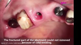 Removal of a fractured implant abutment