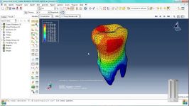 3D Modeling and Stress Analysis of tooth Using FEAAbaqus