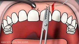 Dental Stitching