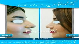 دکتر شروین قوامی  نمونه کار جراحی بینی