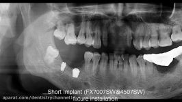 کاشت ایمپلنت کوتاه 7میلیمتری دنتیوم در ناحیه خلفی پایین