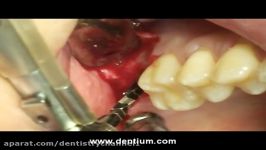 پروتز ایمپلنت Dentium