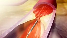 Angioplasty Coronary