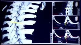 Spine Surgery Using Scopis Holographic Navigation and Microsoft HoloLens