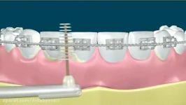 مسواک بین دندانی در ارتودنسی ثابت