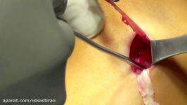 Arthroscopic ACL Reconstruction Detailed