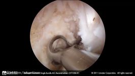 Dr. John Xerogeanes  Anatomic Single Bundle ACL Reconstruction Using XO Button®  ConMed