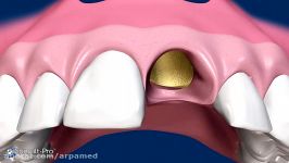 Delayed Implant Placement Following Socket Grafting