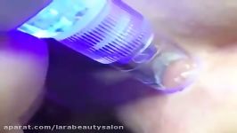 پاکسازی پوست Microdermabrasion