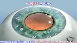 درمان کاتاراکت یا آب مروارید  مرکز چشم پزشکی دکتر علیرضا نادری