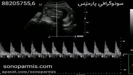 تپش قلب جنین در سونوگرافی غربالگری سه ماهه دوم