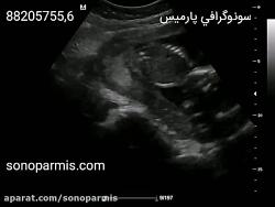پاهای جنین در سونوگرافی انومالی اسكن