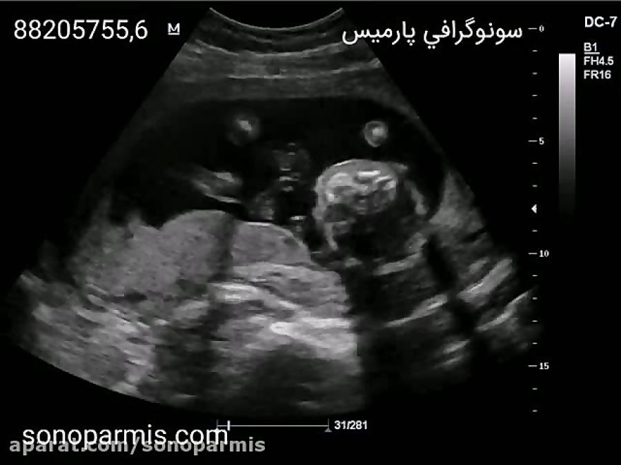 تشخیص جنسیت جنین پسر در سونوگرافی انومالی