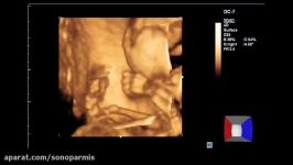 دست پا صورت جنین در سونوگرافی سه بعدی