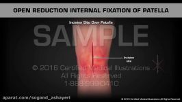 Open Reduction Internal Fixation of Patella