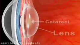 Cataract And Blurry Vision Treatment At Sharp Sight Group of Eye Hospitals