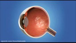 What Causes Eye Floaters and Blurred Vision  Symptoms and Treatment For Eye Floaters
