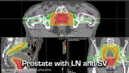 The MEVION S250i Proton Therapy System