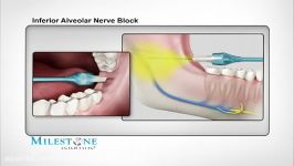 تکنیک تزریق آلوئولار تحتانی STA