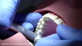 آماده سازی دندان مولر اول راست بالاجهت روکش متال سرامیک