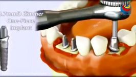 Latest Technology Dentistry Easily of Future Latest Techniques USA Dental implants Fastest Works
