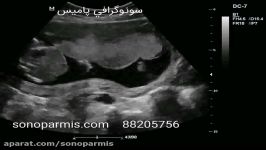 بررسی پاهای جنین