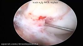 بازسازی آرتروسکوپیک ACL