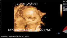 صورت جنین در سونوگرافی سه بعدی