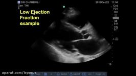 EPSS assessing left ventricle function video 1