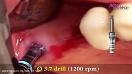 Sinus All Kit Crestal sinus elevation with SCA technique