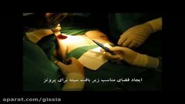 prosthesis  پروتز سینه