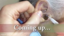 Ear Wax Removal Doctor  Auburn Medical Group