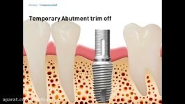 Temporary restoration using Dentium Temporary Shell