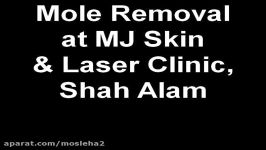 Mole Removal at MJ Skin + Laser Clinic